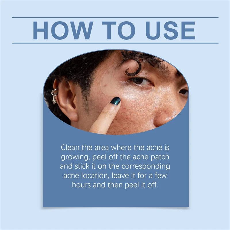 Hydrocolloid Acne Patches